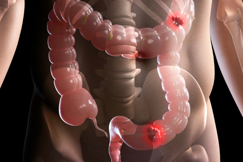 Why Is Colorectal Cancer Increasing in Younger Adults?